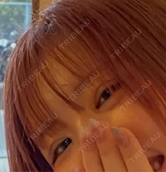 二重埋没 / 目頭切開 GRACIA clinic 【グラシアクリニック】 DAY 19 メイン用