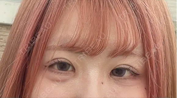 二重埋没 / 目頭切開 GRACIA clinic 【グラシアクリニック】 DAY 42 メイン用