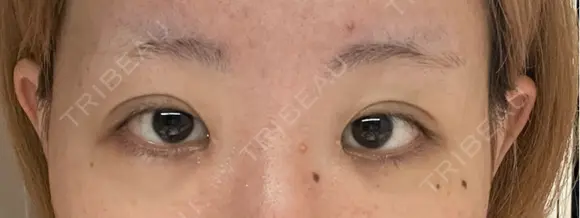 二重埋没 / 目頭切開 GRACIA clinic 【グラシアクリニック】 DAY 55 メイン用