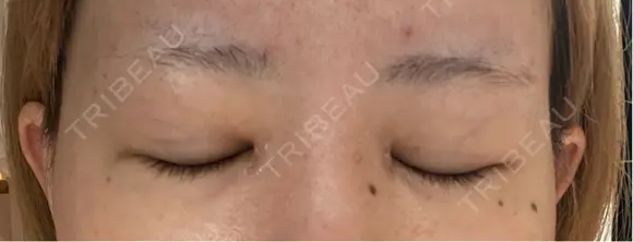 二重埋没 / 目頭切開 GRACIA clinic 【グラシアクリニック】 DAY 55 メイン用