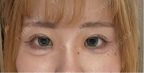 二重埋没 / 目頭切開 GRACIA clinic 【グラシアクリニック】 DAY 55 メイン用