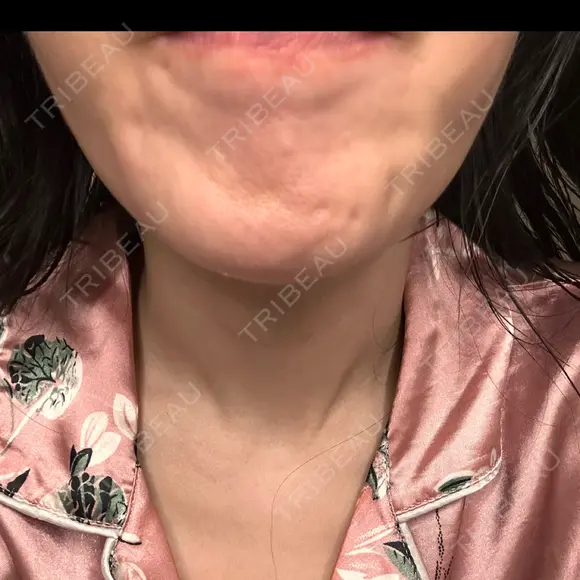 ボトックス（あご） / ボトックス（目尻） ルラ美容クリニック 新宿院 DAY 0 メイン用