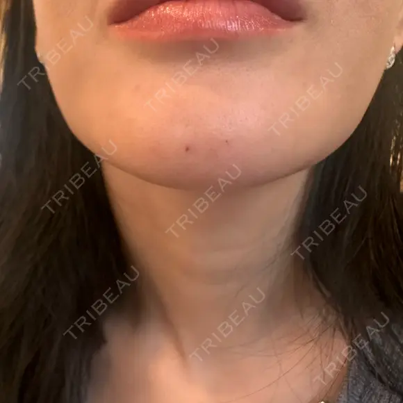 ボトックス（あご） / ボトックス（目尻） ルラ美容クリニック 新宿院 DAY 0 メイン用