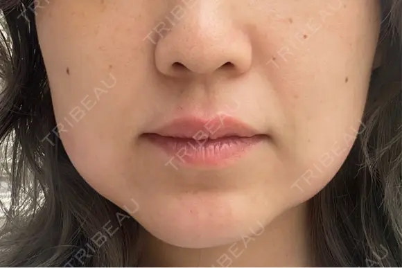 ボトックス（あご） / ボトックス（エラ・小顔） / 脂肪溶解注射（顔） / ボトックス（人中） Kinshicho Beauty Clinic （錦糸町ビューティークリニック） DAY 0 メイン用