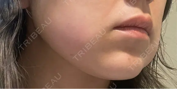ボトックス（あご） / ボトックス（エラ・小顔） / 脂肪溶解注射（顔） / ボトックス（人中） Kinshicho Beauty Clinic （錦糸町ビューティークリニック） DAY 0 メイン用