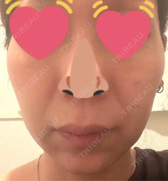 ハイフ（顔） しんゆり美容健康クリニック AFTER メイン用