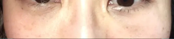 クマ治療 / 下まぶたたるみ取り 二子玉川美容外科クリニック DAY 8 メイン用