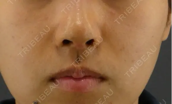 隆鼻術 / 鼻尖形成（切開） / 鼻中隔延長（切開） GRACIA clinic 【グラシアクリニック】 DAY 7 メイン用