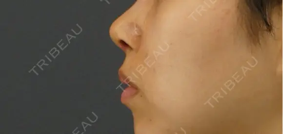 隆鼻術 / 鼻尖形成（切開） / 鼻中隔延長（切開） GRACIA clinic 【グラシアクリニック】 DAY 7 メイン用