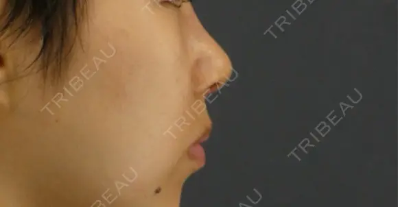 隆鼻術 / 鼻尖形成（切開） / 鼻中隔延長（切開） GRACIA clinic 【グラシアクリニック】 DAY 7 メイン用