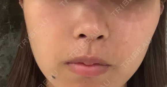 隆鼻術 / 鼻尖形成（切開） / 鼻中隔延長（切開） GRACIA clinic 【グラシアクリニック】 DAY 42 メイン用