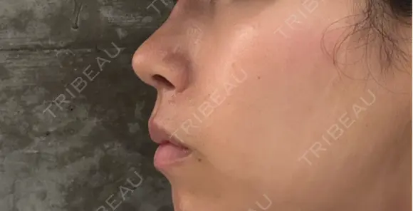 隆鼻術 / 鼻尖形成（切開） / 鼻中隔延長（切開） GRACIA clinic 【グラシアクリニック】 DAY 42 メイン用