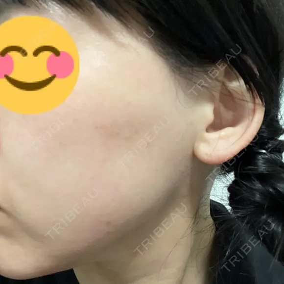 ヴェルヴェットスキン ゆう美容クリニック DAY 6 メイン用