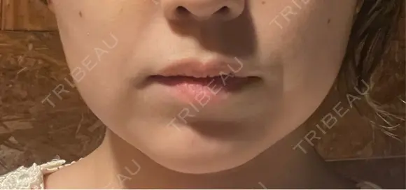 ボトックス（あご） / ボトックス（エラ・小顔） / 脂肪溶解注射（顔） / ボトックス（人中） Kinshicho Beauty Clinic （錦糸町ビューティークリニック） DAY 1 メイン用