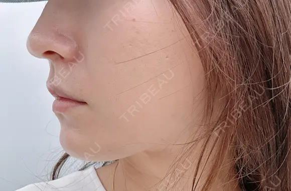 糸リフト 目白ホワイトクリニック DAY 21 メイン用