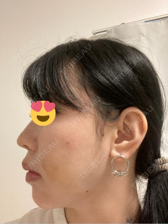 ヒアルロン酸注入（鼻） プリモ麻布十番クリニック DAY 1 メイン用
