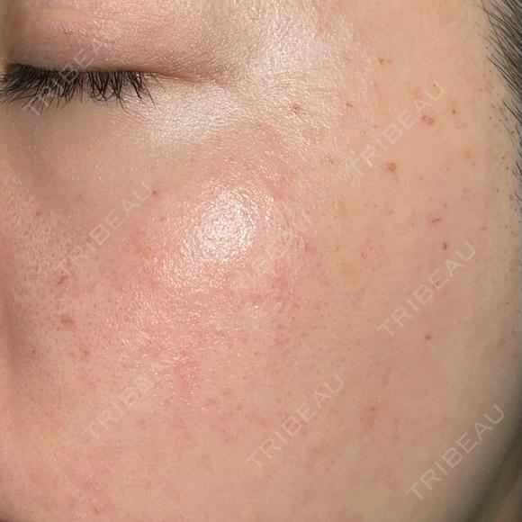 ピーリング（ハリ・ツヤ） / ルメッカ PureMe Skin Clinic（ピュアミースキンクリニック麻布） DAY 0 メイン用