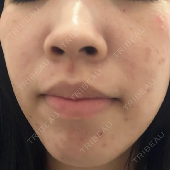 医療脱毛（全身） / ルメッカ Grias clinic （ジリアスクリニック） DAY 0 メイン用