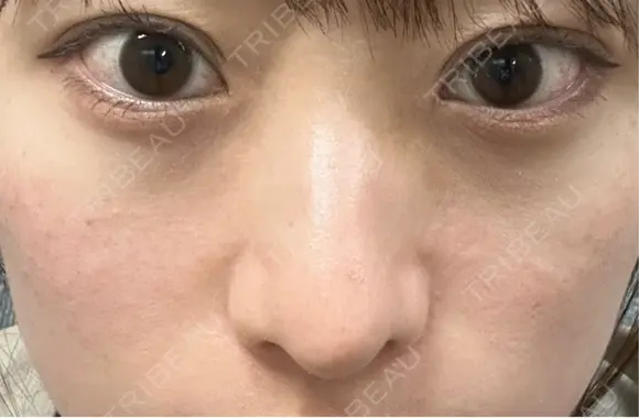 軟骨移植 / 目元修正 / 自然癒着法 / 鼻尖形成（非切開） eクリニック 福岡院 DAY 28 メイン用