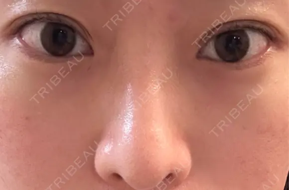 軟骨移植 / 目元修正 / 自然癒着法 / 鼻尖形成（非切開） eクリニック 福岡院 DAY 91 メイン用