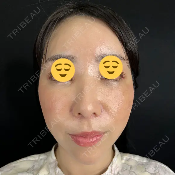 クマ治療 / 脂肪注入（目の下） 藤・ナチュレ美容クリニック 銀座院 DAY 7 メイン用