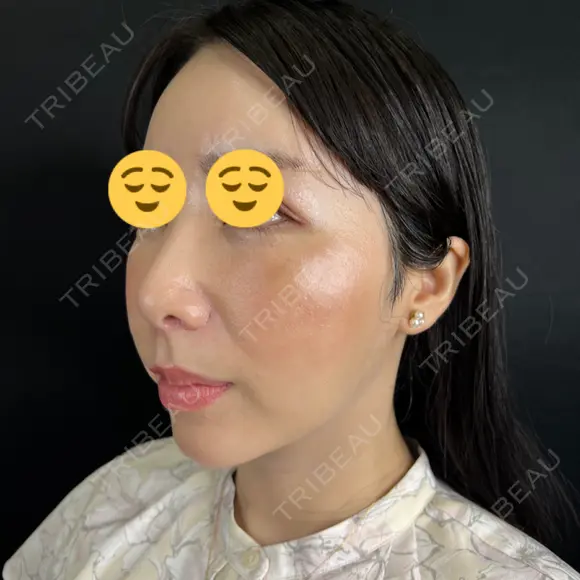 クマ治療 / 脂肪注入（目の下） 藤・ナチュレ美容クリニック 銀座院 DAY 7 メイン用