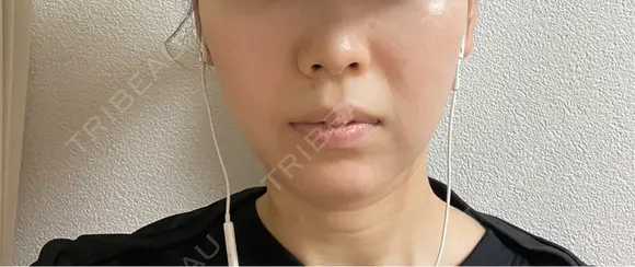 ボトックス（エラ・小顔） ルラ美容クリニック 名古屋本院 DAY 19 メイン用