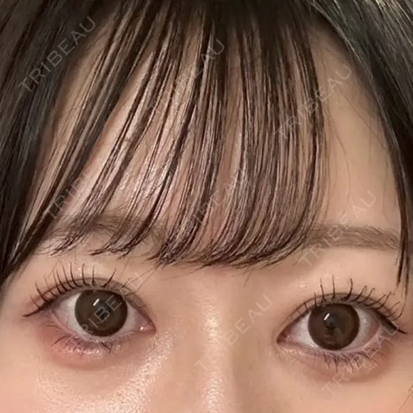 目頭切開 Brandnew Beauty Clinic DAY 194 メイン用
