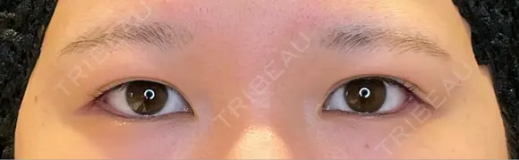 目尻切開 / タレ目形成・グラマラスライン（埋没） LOUIS CLINIC 二子玉川院【ルイクリニック】 AFTER メイン用