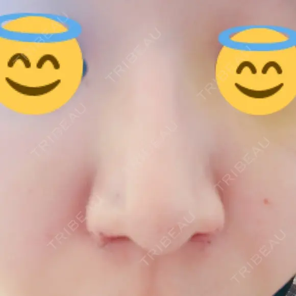 鼻孔縁挙上 / その他（鼻） シエルクリニック DAY 5 メイン用