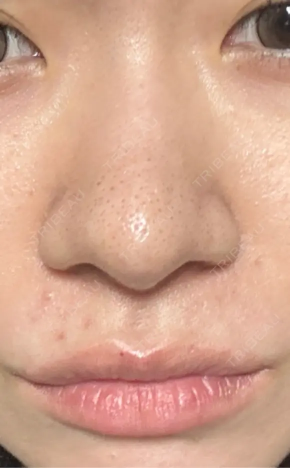 鼻尖形成（切開） / 軟骨移植 / 鼻柱下降・鼻唇角形成（猫手術） 東京美専クリニック AFTER メイン用