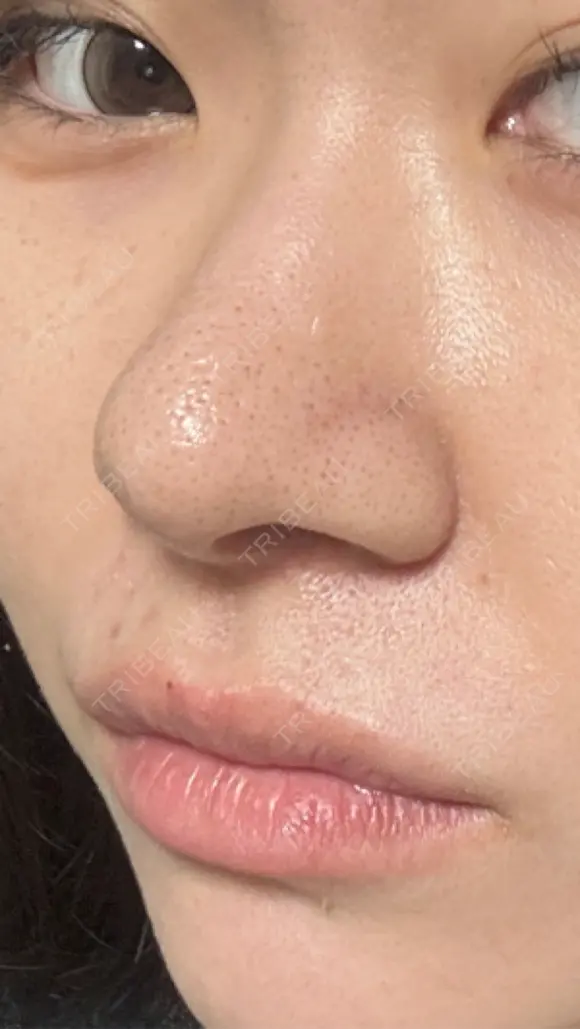 鼻尖形成（切開） / 軟骨移植 / 鼻柱下降・鼻唇角形成（猫手術） 東京美専クリニック DAY 23 メイン用