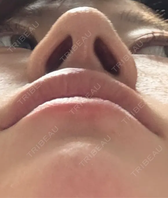 鼻尖形成（切開） / 軟骨移植 / 鼻柱下降・鼻唇角形成（猫手術） 東京美専クリニック DAY 23 メイン用