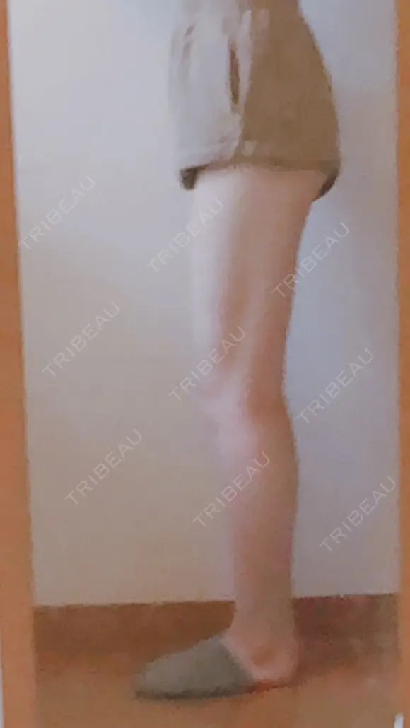 脂肪吸引（脚） ドクターフィット（Dr.fit）クリニック AFTER メイン用