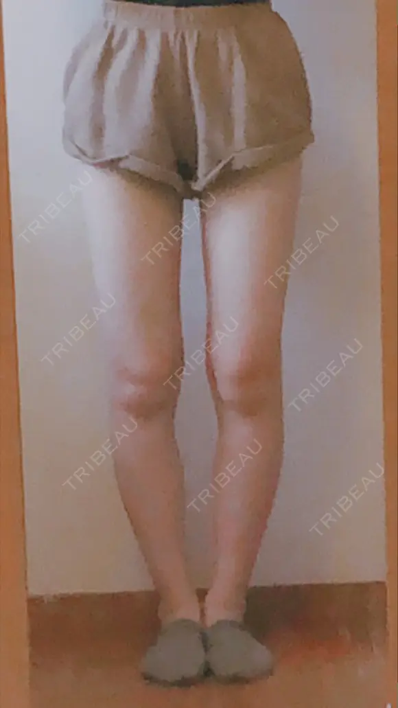 脂肪吸引（脚） ドクターフィット（Dr.fit）クリニック DAY 15 メイン用