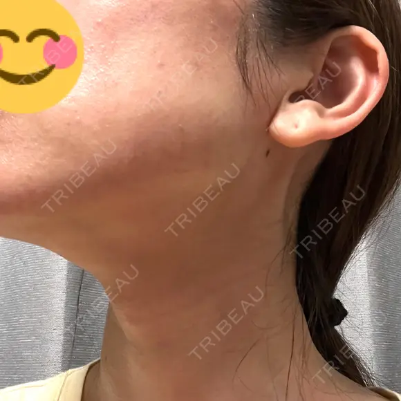 RF（高周波）たるみ治療 Clinic K Blossom DAY 0 メイン用