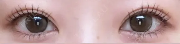 二重埋没 Stand by Beauty Clinic AFTER メイン用
