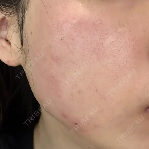 エレクトロポレーション / ルメッカ ON-CLINIC Beauty DAY 0 メイン用