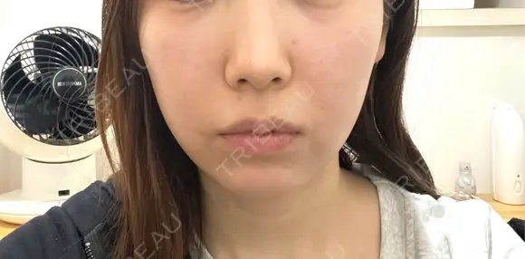 ボトックス（エラ・小顔） ルラ美容クリニック 名古屋本院 AFTER メイン用