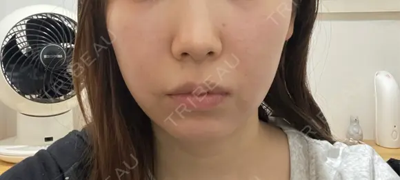 脂肪吸引（顔） ルラ美容クリニック 名古屋栄院 / ルラスキンクリニック 名古屋栄院 AFTER メイン用
