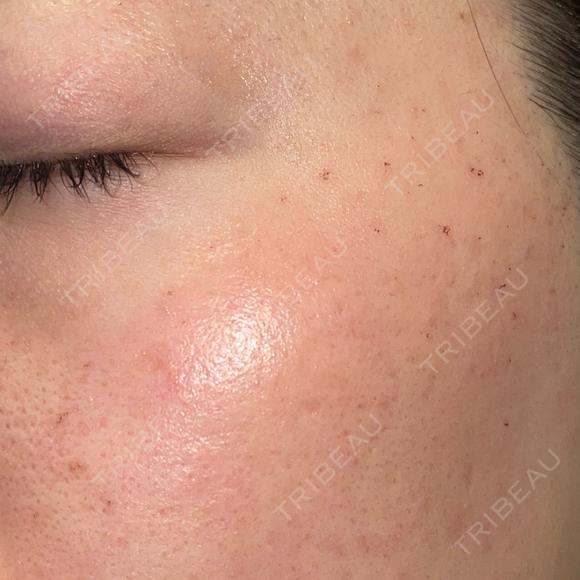 ピーリング（ハリ・ツヤ） / ルメッカ PureMe Skin Clinic（ピュアミースキンクリニック麻布） DAY 1 メイン用