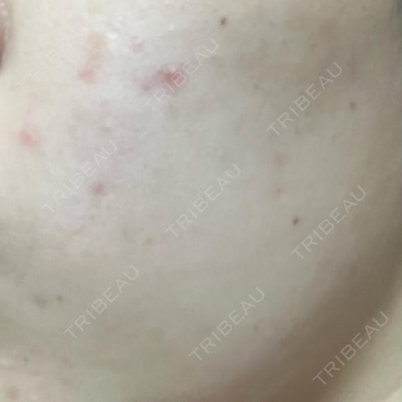 医療脱毛（全身） / ルメッカ Grias clinic （ジリアスクリニック） DAY 2 メイン用