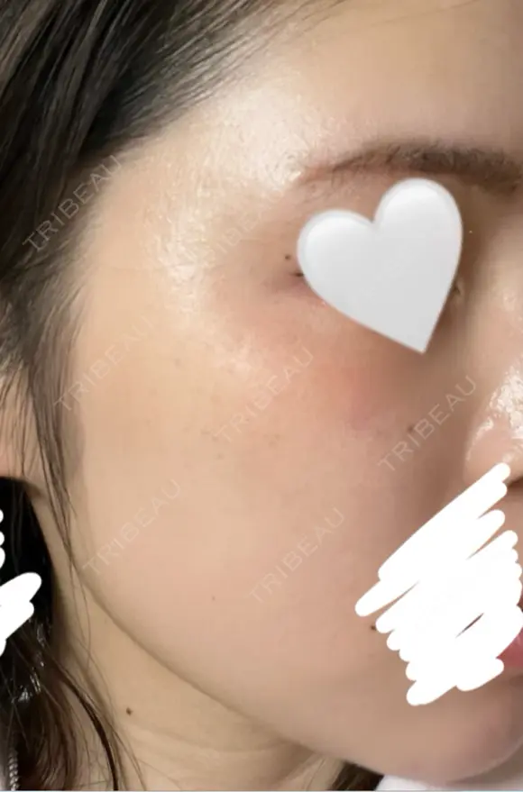 ほくろ・いぼ除去レーザー（肌） / シミ取りレーザー eクリニック 金沢本院 AFTER メイン用