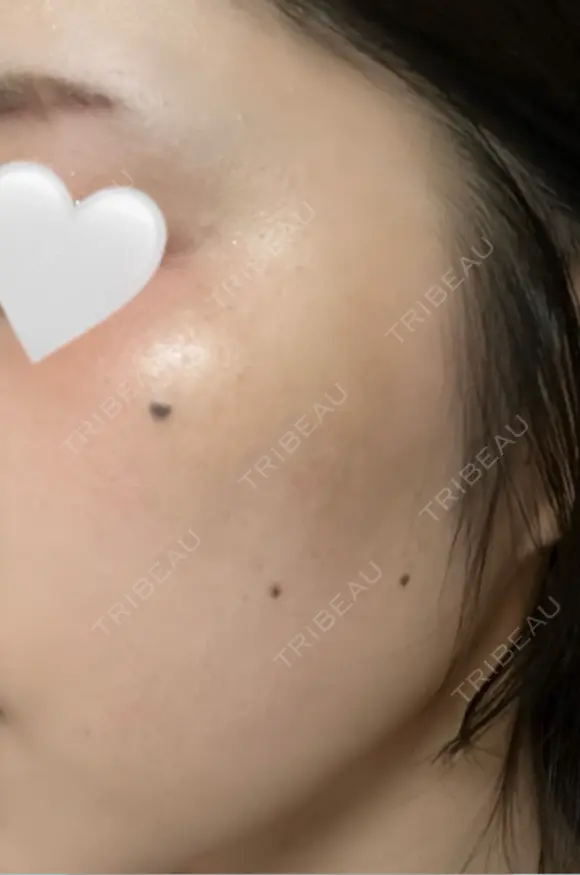 ほくろ・いぼ除去レーザー（肌） / シミ取りレーザー eクリニック 金沢本院 DAY 12 メイン用