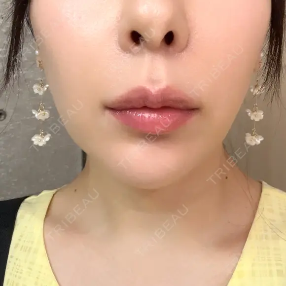 RF（高周波）たるみ治療 Clinic K Blossom DAY 2 メイン用