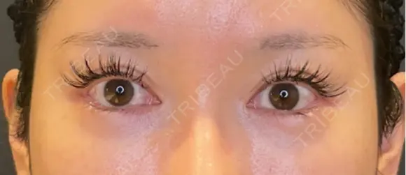 目尻切開 / タレ目形成・グラマラスライン（埋没） / 美容点滴・美容注射（美肌） LOUIS CLINIC 二子玉川院【ルイクリニック】 AFTER メイン用