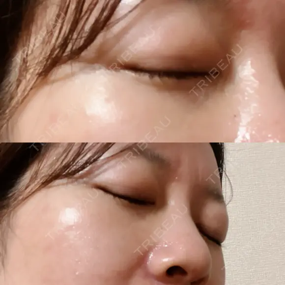 下まぶたの脂肪取り 品川美容外科 渋谷院（※品川スキンクリニック提携） DAY 3 メイン用