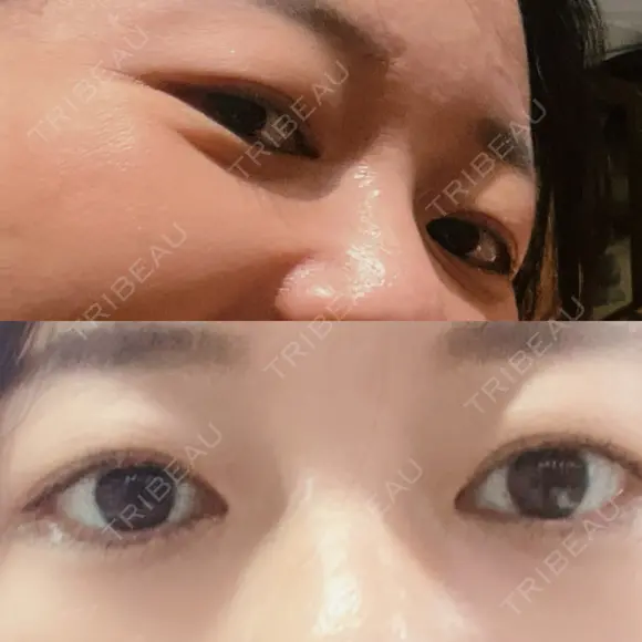 下まぶたの脂肪取り 品川美容外科 渋谷院（※品川スキンクリニック提携） DAY 17 メイン用