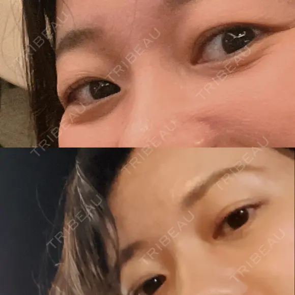 下まぶたの脂肪取り 品川美容外科 渋谷院（※品川スキンクリニック提携） DAY 18 メイン用