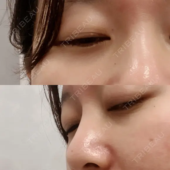 下まぶたの脂肪取り 品川美容外科 渋谷院（※品川スキンクリニック提携） DAY 20 メイン用